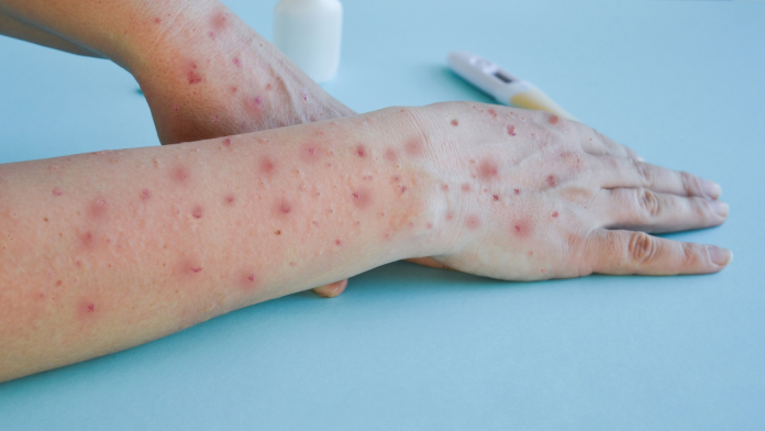 MPOX1