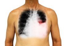 Cáncer al pulmón: síntomas de alerta para acudir al médico