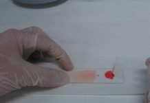 Hospital implementa nuevo examen para la detección precoz de enfermedad de Chagas en recién nacidos
